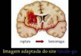 /album/galeria-de-fotos/hemorragiaintracraneal-jpg/